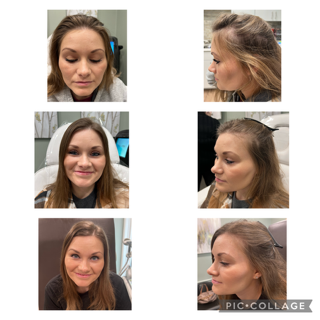 TED Alma Hair Restoration before and after pictures.