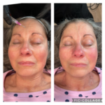 PRX Peel before and after.